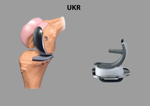 Partial Knee Replacment (UKR)