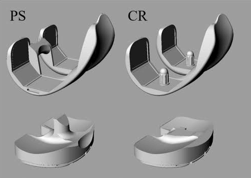 Cruciate Retaining (CR) Total Knee Replacement and Posterior Stabilized (PS) Total Knee Replacement