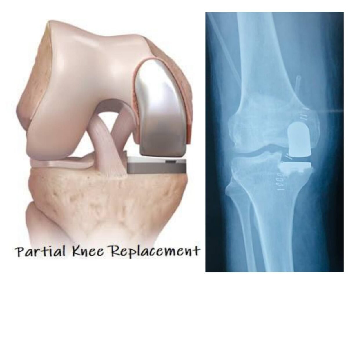 Unicompartmental Knee Replacement